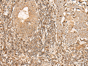 Immunohistochemistry of paraffin-embedded Human esophagus cancer tissue using GALR2 Polyclonal Antibody at dilution of 1:40 (×200)