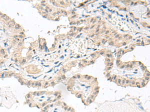 Immunohistochemistry of paraffin-embedded Human thyroid cancer tissue using GFI1B Polyclonal Antibody at dilution of 1:80 (×200)