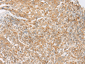 Immunohistochemistry of paraffin-embedded Human cervical cancer tissue using MBOAT4 Polyclonal Antibody at dilution of 1:30 (×200)