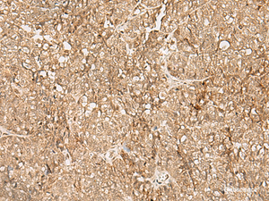 Immunohistochemistry of paraffin-embedded Human ovarian cancer tissue using SNAPC5 Polyclonal Antibody at dilution of 1:25 (×200)