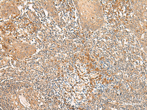 Immunohistochemistry of paraffin-embedded Human tonsil tissue using WLS Polyclonal Antibody at dilution of 1:50 (×200)