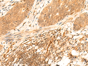 Immunohistochemistry of paraffin-embedded Human esophagus cancer tissue using HES7 Polyclonal Antibody at dilution of 1:25 (×200)