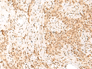 Immunohistochemistry of paraffin-embedded Human ovarian cancer tissue using HIST1H1D Polyclonal Antibody at dilution of 1:55 (×200)