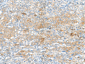 Immunohistochemistry of paraffin-embedded Human cervical cancer tissue using HLA-DRB3 Polyclonal Antibody at dilution of 1:50 (×200)