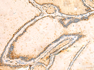 Immunohistochemistry of paraffin-embedded Human thyroid cancer tissue using IGFBPL1 Polyclonal Antibody at dilution of 1:55 (×200)