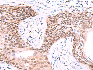 Immunohistochemistry of paraffin-embedded Human esophagus cancer tissue using IRF2BP1 Polyclonal Antibody at dilution of 1:40 (×200)