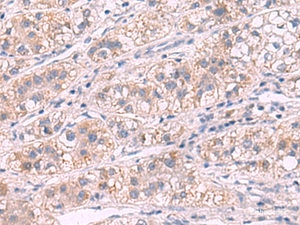 Immunohistochemistry of paraffin-embedded Human liver cancer tissue using G6PC Polyclonal Antibody at dilution of 1:50 (×200)