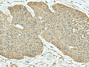 Immunohistochemistry of paraffin-embedded Human esophagus cancer tissue using FN3KRP Polyclonal Antibody at dilution of 1:55 (×200)