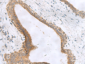 Immunohistochemistry of paraffin-embedded Human breast cancer tissue using CEMIP Polyclonal Antibody at dilution of 1:120 (×200)