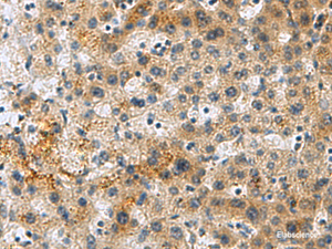 Immunohistochemistry of paraffin-embedded Human liver cancer tissue using PLIN4 Polyclonal Antibody at dilution of 1:50 (×200)