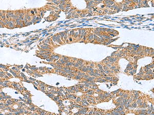 Immunohistochemistry of paraffin-embedded Human colorectal cancer tissue using CLEC1B Polyclonal Antibody at dilution of 1:60 (×200)