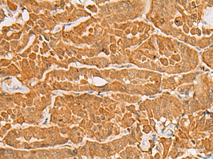 Immunohistochemistry of paraffin-embedded Human thyroid cancer tissue using MAPK14 Polyclonal Antibody at dilution of 1:60 (×200)