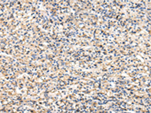 Immunohistochemistry of paraffin-embedded Human prost at e cancer tissue using VCAM1 Polyclonal Antibody at dilution of 1:30 (×200)