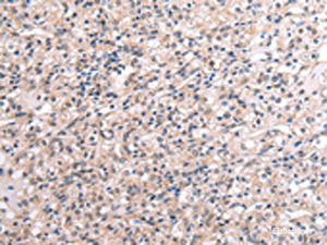 Immunohistochemistry of paraffin-embedded Human liver cancer tissue using RNF115 Polyclonal Antibody at dilution of 1:45 (×200)