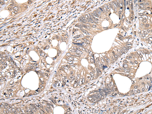 Immunohistochemistry of paraffin-embedded Human colorectal cancer tissue using GCNT2 Polyclonal Antibody at dilution of 1:60 (×200)