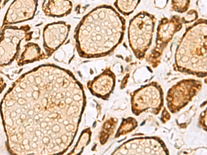 Immunohistochemistry of paraffin-embedded Human thyroid cancer tissue using LRRC2 Polyclonal Antibody at dilution of 1:55 (×200)