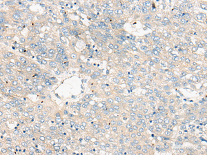 Immunohistochemistry of paraffin-embedded Human liver cancer tissue using ZNF449 Polyclonal Antibody at dilution of 1:50 (×200)