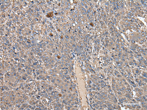 Immunohistochemistry of paraffin-embedded Human liver cancer tissue using ATAD1 Polyclonal Antibody at dilution of 1:50 (×200)