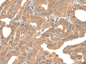 Immunohistochemistry of paraffin-embedded Human thyroid cancer tissue using PPP3R1 Polyclonal Antibody at dilution of 1:55 (×200)