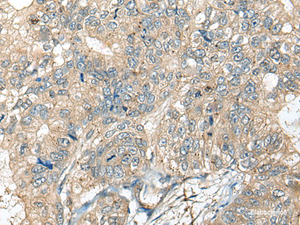 Immunohistochemistry of paraffin-embedded Human gastric cancer tissue using CASR Polyclonal Antibody at dilution of 1:60 (×200)