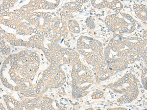 Immunohistochemistry of paraffin-embedded Human liver cancer tissue using HLA-DRB5 Polyclonal Antibody at dilution of 1:45 (×200)