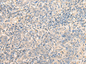 Immunohistochemistry of paraffin-embedded Human cervical cancer tissue using MR1 Polyclonal Antibody at dilution of 1:40 (×200)