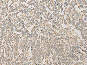 Immunohistochemistry of paraffin-embedded Human lung cancer tissue using FYTTD1 Polyclonal Antibody at dilution of 1:30 (×200)