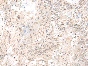 Immunohistochemistry of paraffin-embedded Human esophagus cancer tissue using ILKAP Polyclonal Antibody at dilution of 1:50 (×200)