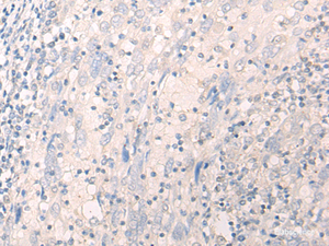 Immunohistochemistry of paraffin-embedded Human cervical cancer tissue using LILRA2 Polyclonal Antibody at dilution of 1:40 (×200)