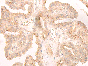 Immunohistochemistry of paraffin-embedded Human thyroid cancer tissue using LCMT2 Polyclonal Antibody at dilution of 1:45 (×200)