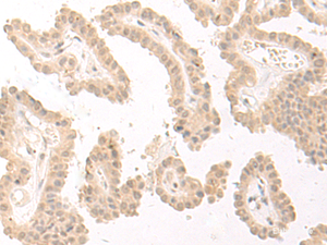 Immunohistochemistry of paraffin-embedded Human thyroid cancer tissue using PBXIP1 Polyclonal Antibody at dilution of 1:40 (×200)