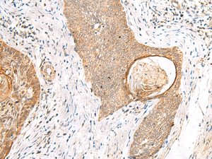 Immunohistochemistry of paraffin-embedded Human esophagus cancer tissue using TOR1A Polyclonal Antibody at dilution of 1:35 (×200)