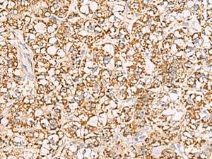 Immunohistochemistry of paraffin-embedded Human liver cancer tissue using ISOC2 Polyclonal Antibody at dilution of 1:95 (×200)