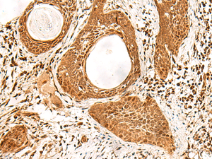 Immunohistochemistry of paraffin-embedded Human esophagus cancer tissue using ADRM1 Polyclonal Antibody at dilution of 1:70 (×200)