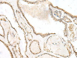 Immunohistochemistry of paraffin-embedded Human thyroid cancer tissue using LIG4 Polyclonal Antibody at dilution of 1:40 (×200)