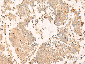 Immunohistochemistry of paraffin-embedded Human lung cancer tissue using TEX11 Polyclonal Antibody at dilution of 1:30 (×200)