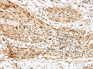 Immunohistochemistry of paraffin-embedded Human esophagus cancer tissue using RBM15 Polyclonal Antibody at dilution of 1:70 (×200)