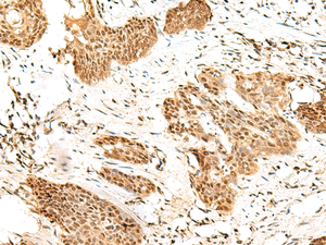 Immunohistochemistry of paraffin-embedded Human esophagus cancer tissue using RBM19 Polyclonal Antibody at dilution of 1:45 (×200)