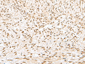 Immunohistochemistry of paraffin-embedded Human liver cancer tissue using GTF2A2 Polyclonal Antibody at dilution of 1:30 (×200)