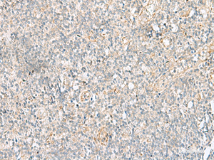 Immunohistochemistry of paraffin-embedded Human tonsil tissue using GSKIP Polyclonal Antibody at dilution of 1:55 (×200)