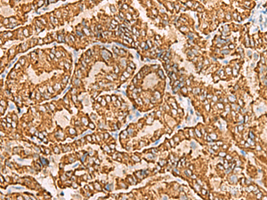 Immunohistochemistry of paraffin-embedded Human thyroid cancer tissue using NPC2 Polyclonal Antibody at dilution of 1:80 (×200)