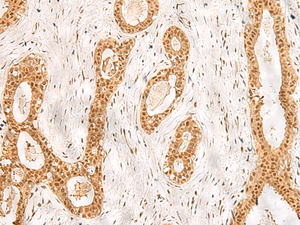 Immunohistochemistry of paraffin-embedded Human breast cancer tissue using RPS27A Polyclonal Antibody at dilution of 1:40 (×200)