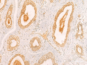 Immunohistochemistry of paraffin-embedded Human breast cancer tissue using ZNF580 Polyclonal Antibody at dilution of 1:40 (×200)