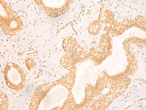 Immunohistochemistry of paraffin-embedded Human breast cancer tissue using GSG1L Polyclonal Antibody at dilution of 1:50 (×200)