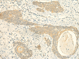 Immunohistochemistry of paraffin-embedded Human esophagus cancer tissue using MPV17 Polyclonal Antibody at dilution of 1:50 (×200)