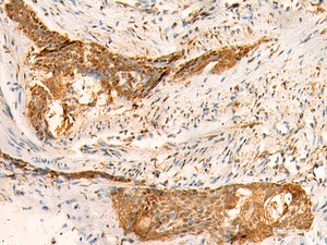 Immunohistochemistry of paraffin-embedded Human esophagus cancer tissue using SMUG1 Polyclonal Antibody at dilution of 1:50 (×200)