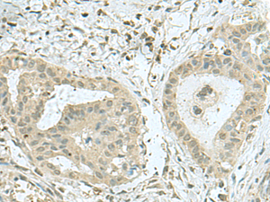 Immunohistochemistry of paraffin-embedded Human thyroid cancer tissue using THTPA Polyclonal Antibody at dilution of 1:70 (×200)