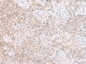 Immunohistochemistry of paraffin-embedded Human ovarian cancer tissue using SMNDC1 Polyclonal Antibody at dilution of 1:50 (×200)