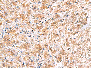 Immunohistochemistry of paraffin-embedded Human liver cancer tissue using PDCL2 Polyclonal Antibody at dilution of 1:65 (×200)