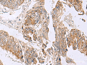 Immunohistochemistry of paraffin-embedded Human colorectal cancer tissue using RTKN2 Polyclonal Antibody at dilution of 1:75 (×200)